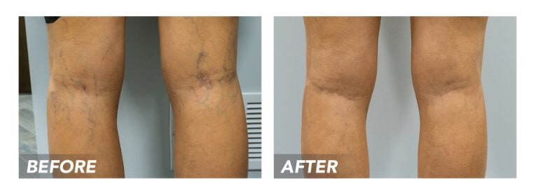 Clip Are you wondering what you can expect from minimally invasive vein treatments? In this article, the best varicose vein center near Farmingdale describes vein treatments.