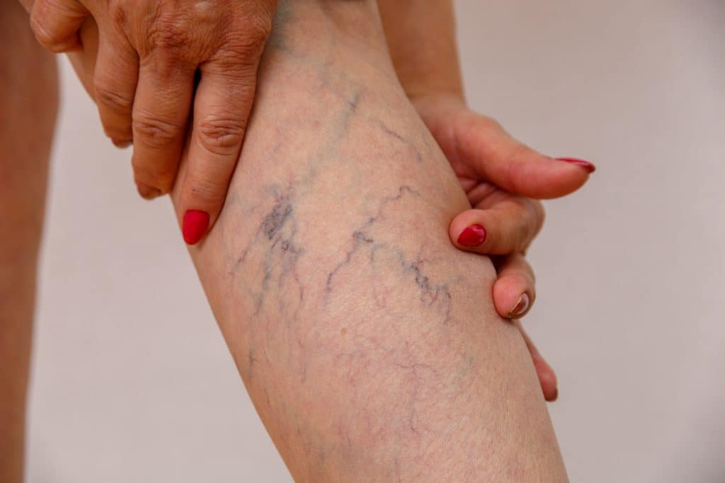 Dr. Caroline Novak is the best vein doctor in Freeport, Long Island. In this article, Dr. Novak discusses varicose veins, spider veins, venous disease, and more.