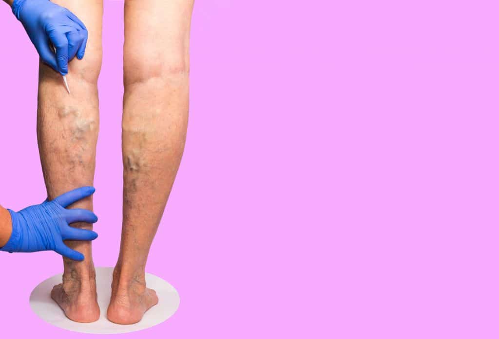 If you have varicose veins, you must find a state-of-the-art vein treatment center with great vein specialists. In this article, we discuss how to find a vein center in Suffolk County, LI.