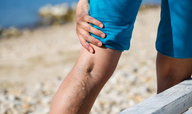  Do you have bulging veins or unsightly varicose veins? In this article, we describe the minimally invasive varicose vein treatment process at our vein center in Massapequa, New York.