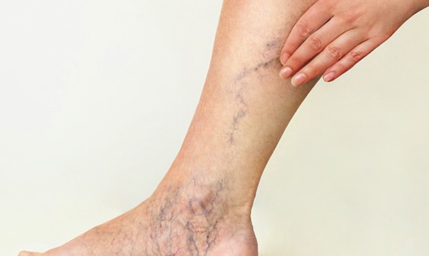 Are you wondering what happens during a varicose vein and spider vein treatment? Our spider vein clinic in Lindenhurst guides you through the entire spider veins treatment process.