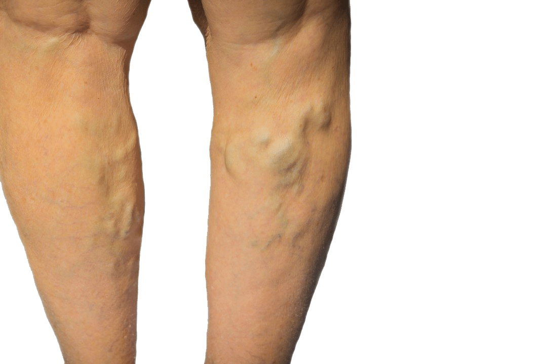 Are you wondering, “should I consult a varicose vein treatment center near me in Islip?” This article highlights the signs and symptoms of vein disease, so you know when to consult a vein doctor.