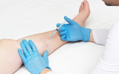 Vein Treatment Cost on Long Island: A Comprehensive Guide